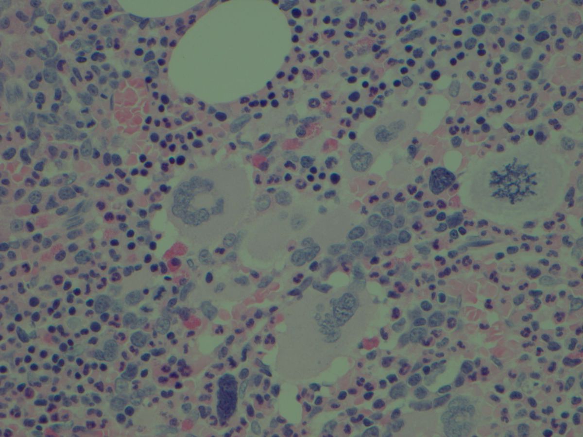 Bone marrow core biopsy with myeloproliferative neoplasm/essential thrombocythemia (400X)